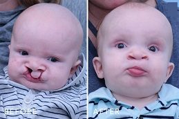 Cleft Lip And Palate Surgery Before & After