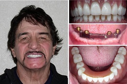Dental Implants Before and After