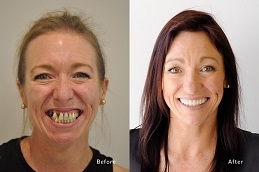 Dental Implants Before and After clinic islamabad