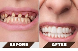 Dental Implants Before and After clinic islamabad,