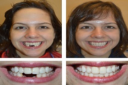 Dental Implants Before and After in islamabad