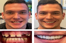 Dental Implants Before and After islamabad