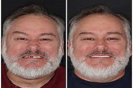 Dental Implants Before and After