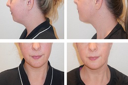 Double Chin Removal b before & After