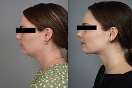 Double Chin Removal b before & After clinic islamabad