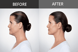 Double Chin Removal b before & After in islamabad