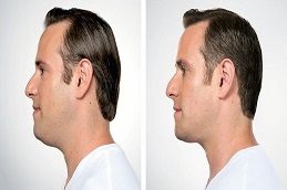 Double Chin Removal b before & After in pakistan