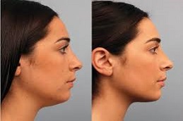 Double Chin Removal b before & After islamabad Pakistan
