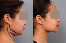 Double Chin Removal b before & After