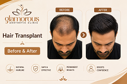 Hair Transplnat Before & After At Glamrous Clinic Islamabad