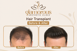 Hair Transplnat Before & After At Glamrous Clinic