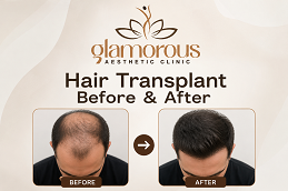 Hair Transplnat Before & After in Islamabad