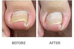 Ingrown Toenail Before and After Islamabad