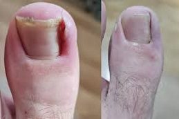 Ingrown Toenail Before and After clinic islmabad