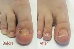 Ingrown Toenail Before and After islamabad ,
