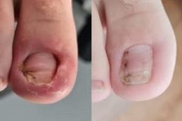 Ingrown Toenail Before and After pakistan