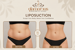 Liposuction Before & After in islamabad