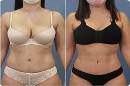Lower Body Lift before & After clinic Pakistan