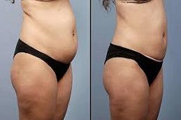 Lower Body Lift before & After clinic islsmabad.