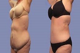 Lower Body Lift before & After clinic islsmabad