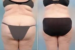 Lower Body Lift before & After in islamabad