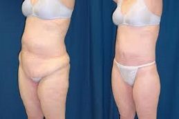 Lower Body Lift before & After in islamabad