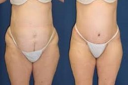 Lower Body Lift before & After in islamabad