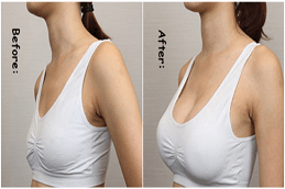 Results OF Breast Fillers in Islamabad