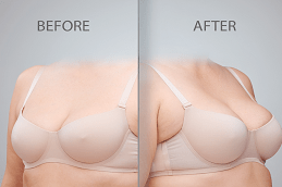 Results OF Breast Surgery in Islamabad