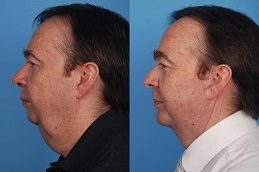 Results OF Cheek Augmentation Islamabad