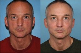 Results OF Cheek Augmentation in Islamabad