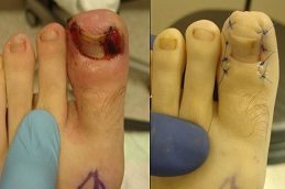 Results OF Ingrown Toenail in Islamabad Pakistan
