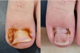 Results OF Ingrown Toenail in Islamabad