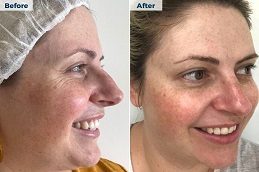 Results OF Steroid Injections Pakistan