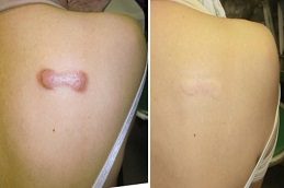 Results OF Steroid Injections in Islamabad Pakistan