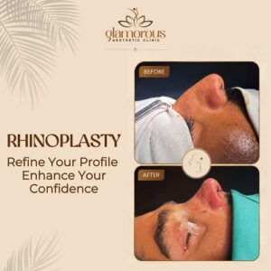 Rhinoplasty Before & After glamrous clinic islmabad