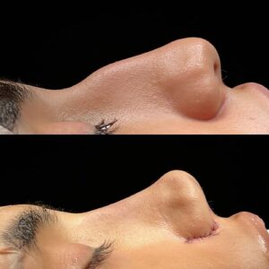 Rinoplasty Before & After Islamabad At Glamorous Clinic.