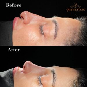 Rinoplasty Before & After Islamabad At Glamorous Clinic,