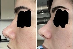 Steroid Injections Before and After clinic islamabad