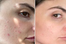 Steroid Injections Before and After islamabad