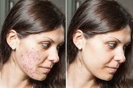 Steroid Injections Before and After