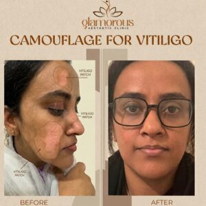 Vitiligo Treatment Before & After At Glamrous Clinic