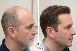 hair Transplant Before & After Glamrous Clinic