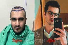 hair Transplnat before & After Clinic in Islamabad