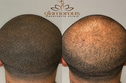 hair Transplnat before & After in Islamabad