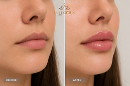 Lip filler injections Before & After Pakistan