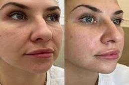 Thread Lift Before & After Pakistan