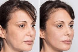 Thread Lift Before & After clinic islamabad,