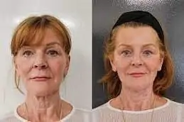 Thread Lift Before & After clinic islamabad Pakistan