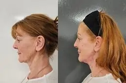 Thread Lift Before & After islamabad Pakistan